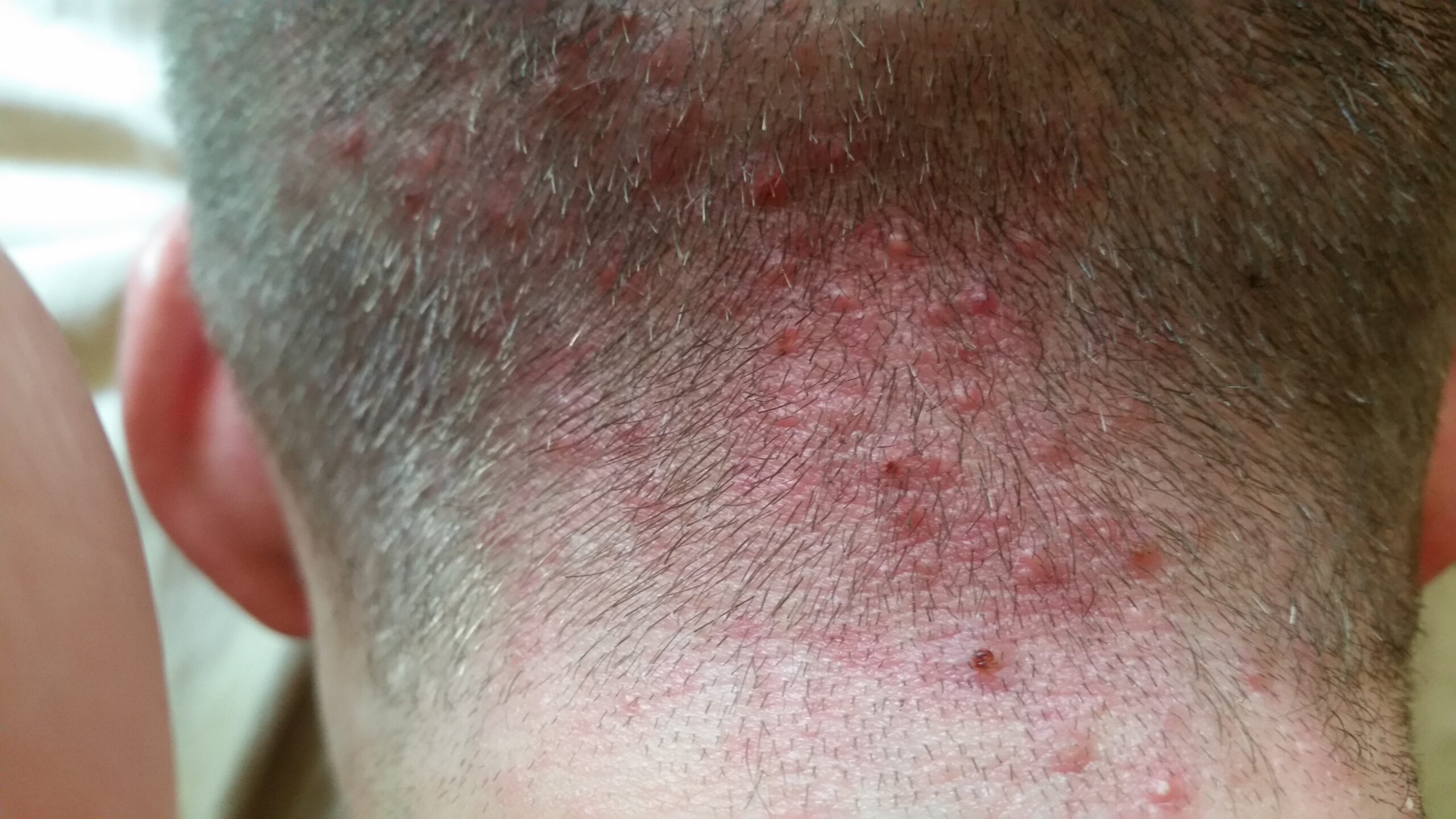 Scalp Pimples and Acne